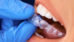Custom Nightguard for Teeth Grinding: Expert Tips for Lasting Relief