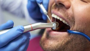 Scaling and Root Planing Treatment