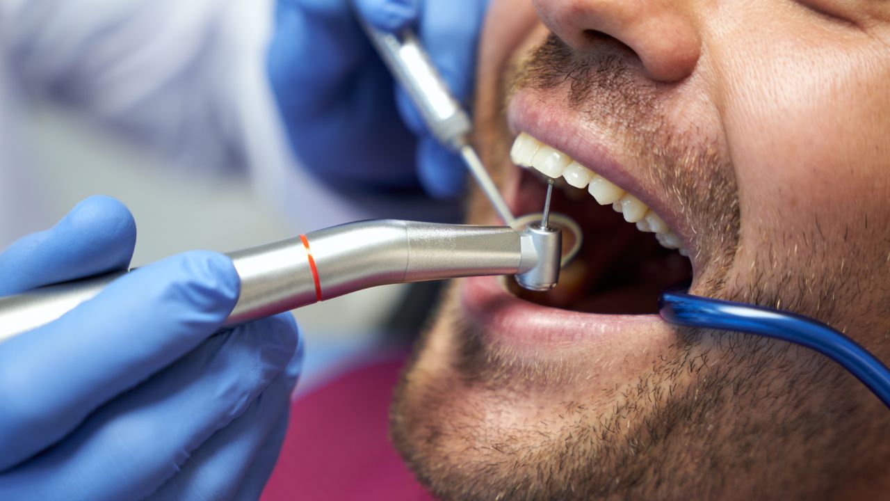 Scaling and Root Planing Treatment